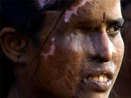 woman with her face scarred from an acid attack in India