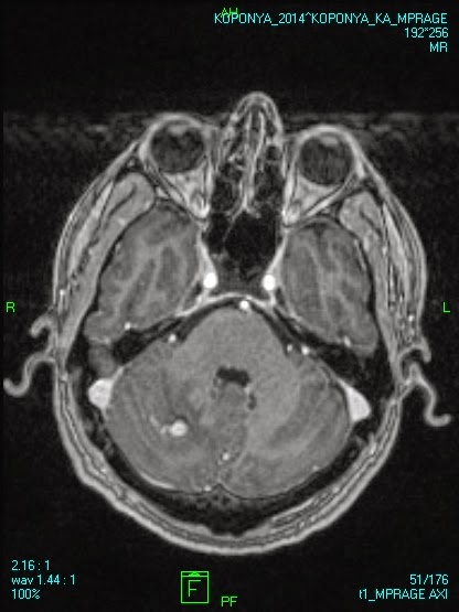 Hemangioblastoma