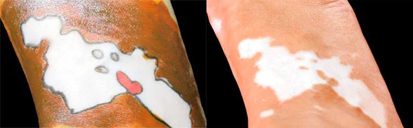 Kartiki-Bhatnagar-y su vitiligo