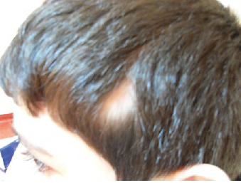 Que es alopecia areata en ninos