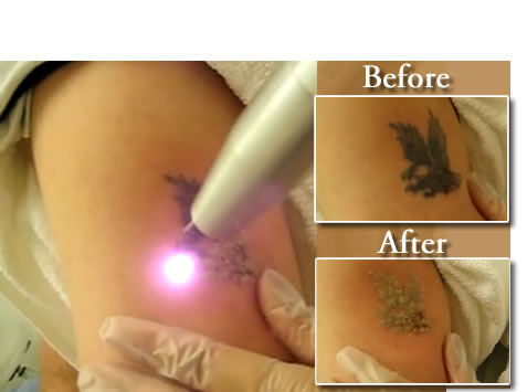 Laser Tattoo Removal Cost | Best 4U