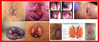 List Obat Wasir Yang bagus Dan Ampuh