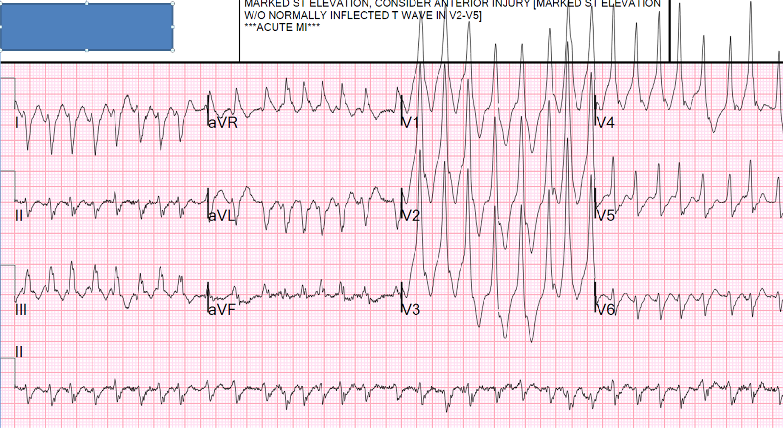 Dr. ECG Blog: Wide Complex Tachycardia, and What Latent Conduction and "Concealed Conduction?"