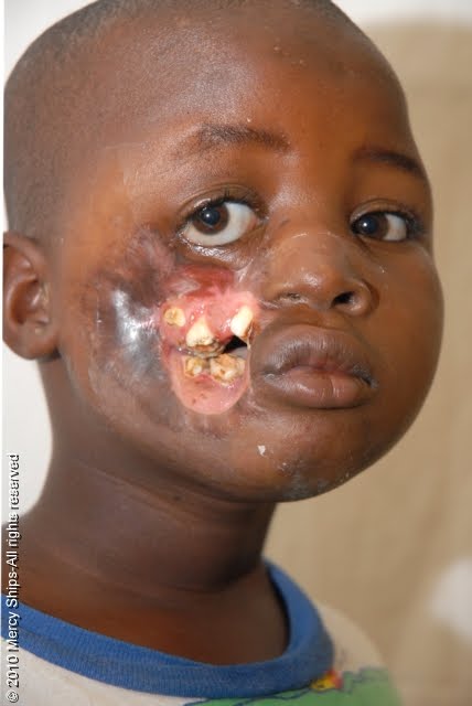 Natural Treatment For Facial Cellulitis Natural Treatment For Facial Cellulitis