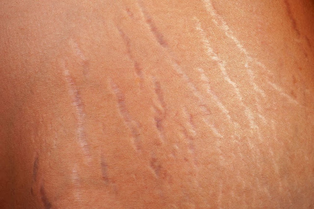 Cara Menghilangkan Stretch Mark Setelah Melahirkan Dengan Cepat Alami Cara Menghilangkan Stretch Mark Setelah Melahirkan Dengan Cepat Alami