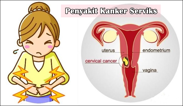 9 Jenis Makanan Yang Harus Di Hindari Bagi Penderita Kanker Serviks 9 Jenis Makanan Yang Harus Di Hindari Bagi Penderita Kanker Serviks