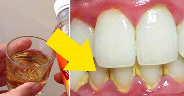 ELIMINA EL SARRO DE LOS DIENTES EN 5 MINUTOS Y NO GASTES MÁS TÚ DINERO EN EL DENTISTA. ELIMINA EL SARRO DE LOS DIENTES EN 5 MINUTOS Y NO GASTES MÁS TÚ DINERO EN EL DENTISTA.