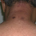 Top 5 Most Dreaded Diabetes Skin Problems You Should Know