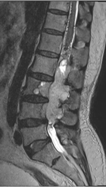 Filum Terminale Conus Medullaris : Professor, department chair, surgeon, neuroscientist and medical informatician in the western hemisphere.