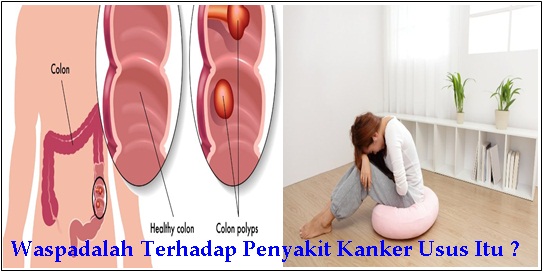 Faktor Risiko Penyakit Kanker Usus Faktor Risiko Penyakit Kanker Usus