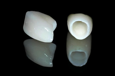 Răng sứ zirconia có độ bền rất cao