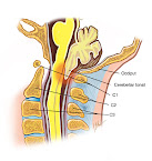 What is Chiari