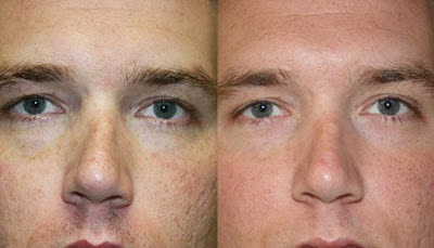 Best option for facial resurfacing