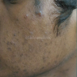 Acne homoeopathic treatment