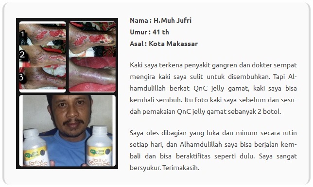 Cara Mengobati Cantengan Parah Bernanah dan Akut Secara Alami Cara Mengobati Cantengan Parah Bernanah dan Akut Secara Alami