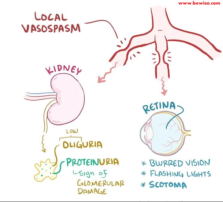MANAGEMENT OF PREECLAMSIA AND ECLAMPSIA WITH MAGNESIUM SULPHATE (MgSO4