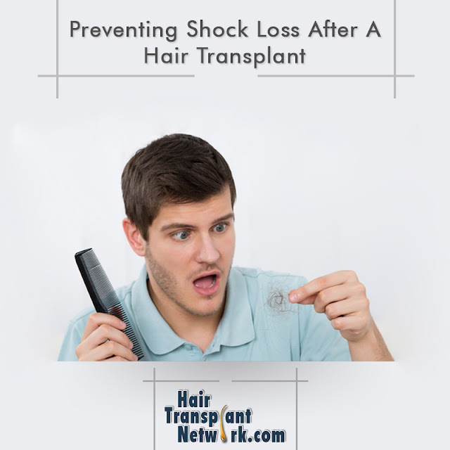 Preventing Shock Loss After A Hair Transplant