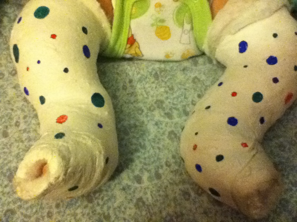 Lilybear, and the Quest of Congenital Talipes Equinovarus Series of