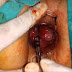 Wasir (Hemoroid) Treatment dengan Ambeclear dan Salep Salwa thumbnail