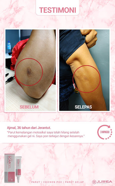 hilangkan parut kemalangan cara berkesan