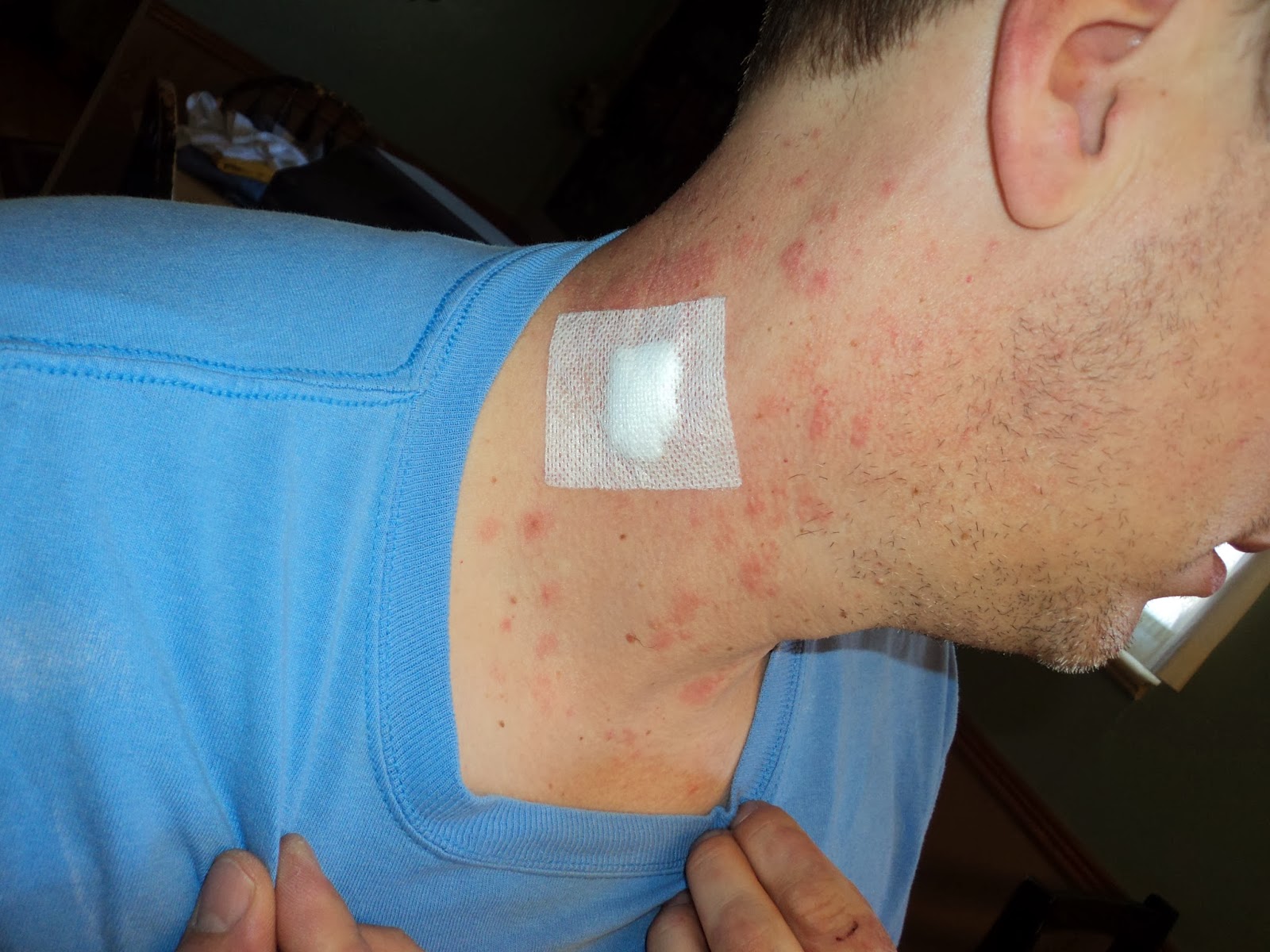 Rock and Roll Warrior: The rash and then some...