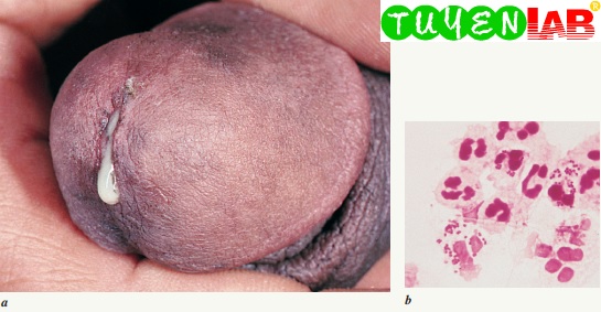 Std Penis Discharge Std Penis Discharge