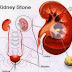What square measure urinary Kidney Stones?