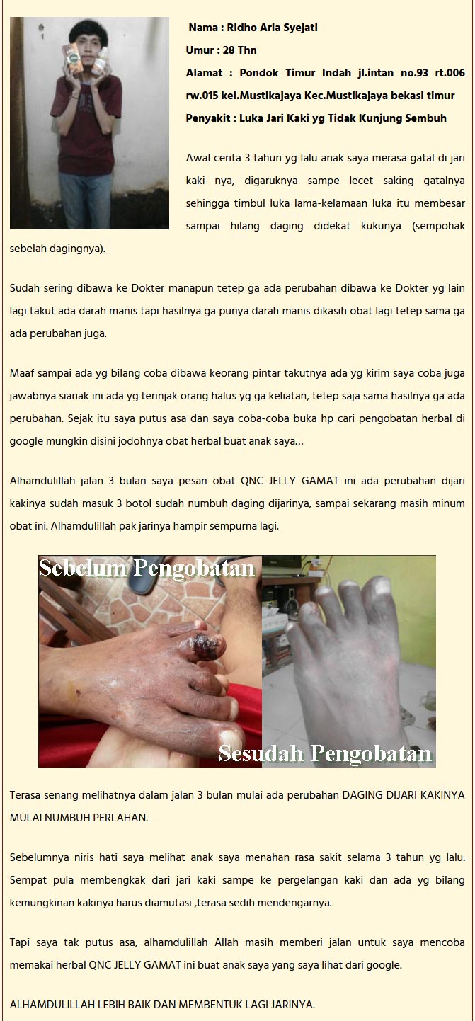 Cara Mengobati Cantengan Parah Bernanah dan Akut Secara Alami Cara Mengobati Cantengan Parah Bernanah dan Akut Secara Alami