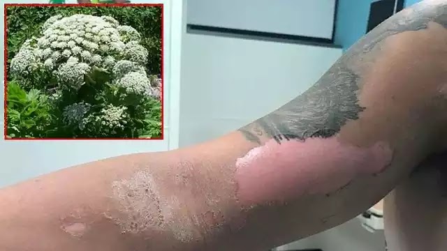 Το γιγαντιαίο ηράκλειο - ένα είδους φυτού που καίει το δέρμα και προκαλεί τύφλωση! VIDEO Το γιγαντιαίο ηράκλειο - ένα είδους φυτού που καίει το δέρμα και προκαλεί τύφλωση! VIDEO
