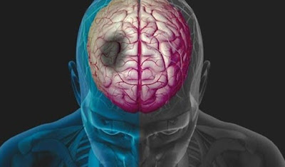 Όγκος στο κεφάλι: Τ συμπτώματα και οι κινήσεις που πρέπει να κάνεις – Μην πανικοβάλλεσαι μπορεί να μην είναι σοβαρό