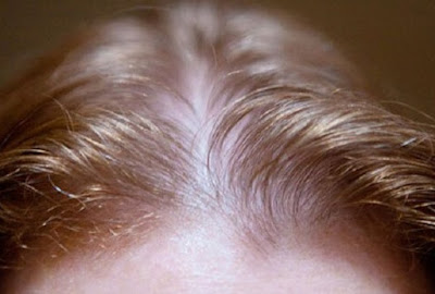 Tìm hiểu về căn bệnh mất tóc ở phụ nữ Mat-toc-co-bieu-hien-nhu-nam-gioi
