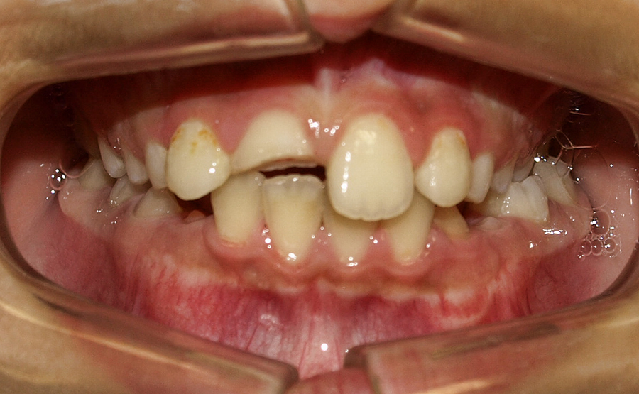 Clinica Omega: Traumatismo dental