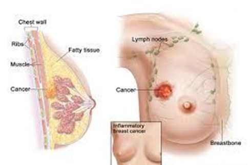 Www.cara menyembuhkan kanker payudara, tanda kanker payudara stadium 4, bahan alami mengobati kanker payudara, obat jawa kanker payudara, penanganan kanker payudara stadium 2, prevalensi kanker payudara di indonesia, kanker payudara obat tradisional, gejala dan cara pengobatan kanker payudara, mengobati kanker payudara stadium 4, obat herbal gejala kanker payudara, mengenal gejala awal kanker payudara