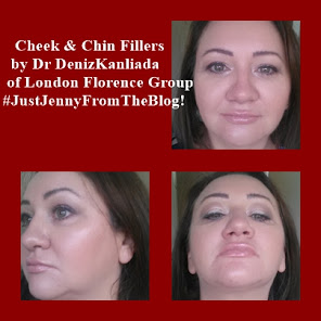 Chin & cheek fillers by Dr Deniz  Kanliada