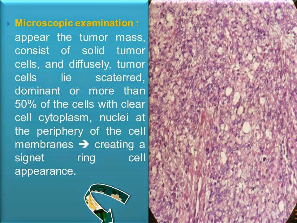 Reza Aditya Digambiro: GASTRIC SIGNET RING CELL CARCINOMA