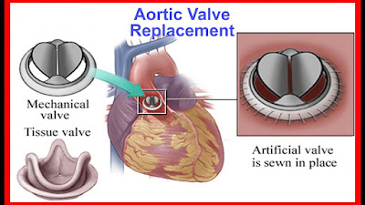 Aortic Valve Replacement