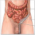 Cara Menyembuhkan Hernia Tanpa Operasi Dengan Obat Hernia Herbal Cara Menyembuhkan Hernia Tanpa Operasi Dengan Obat Hernia Herbal