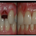 Dile Adiós a Los Implantes Dentales. Cómo hacer crecer un diente en 2 meses