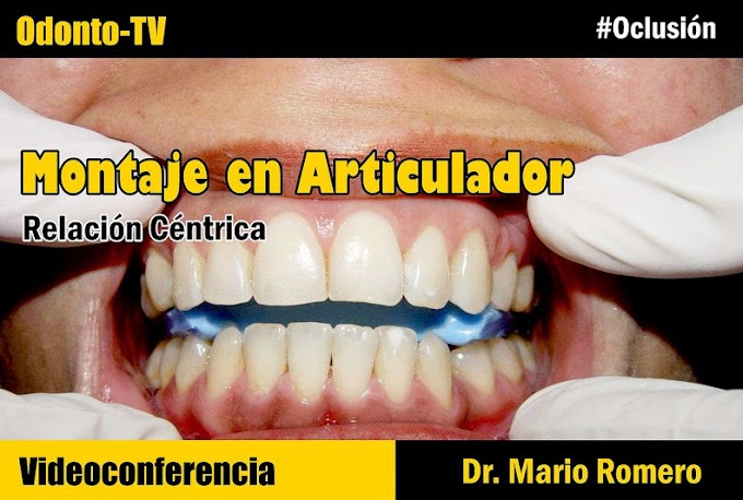 MONTAJE EN ARTICULADOR: Relación Céntrica - Videoconferencia del Dr. Mario Romero 