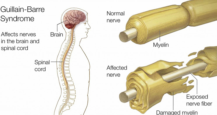 Image result for Guillain-Barre Syndrome