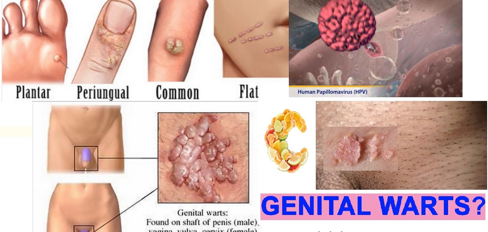 botemedel humant papillom virus
