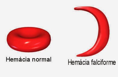 anemia hemácia falciforme