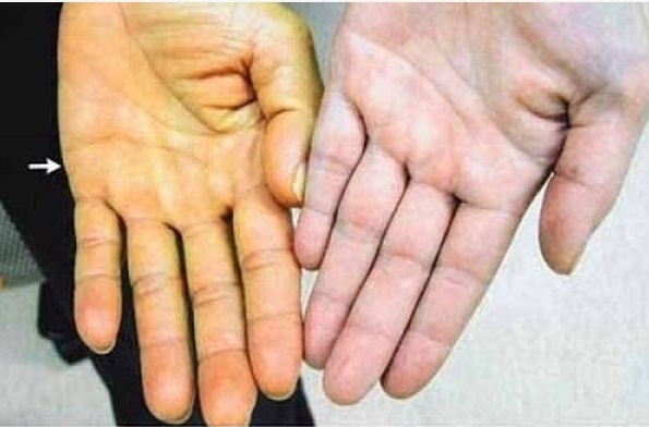 Pengobatan Kanker kandung empedu Pengobatan Kanker kandung empedu