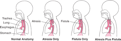 Mr. dan Mrs. Pingu: Resume Atresia Esophagus