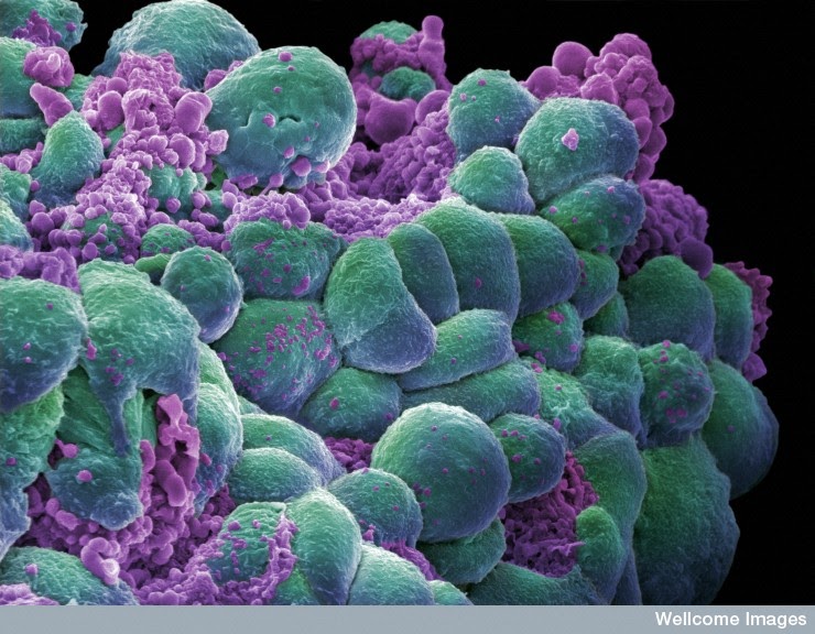 May Heretofore Bowel Cancer Has Spread It Is Very Difficult To Treat Partly Because The Side Effects Of Chemotherapy Albatross Limit How Long Patients Can Have 