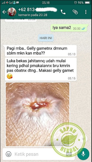 Cara Menyembuhkan Luka Bakar Ringan & Berat Secara Total Cara Menyembuhkan Luka Bakar Ringan & Berat Secara Total