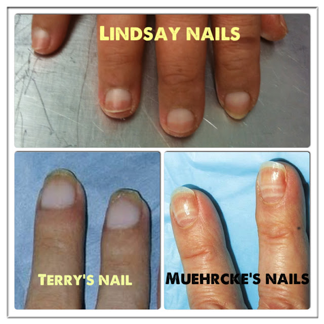 Naut s Medical Tips Apparent Leukonychia Signs Of Internal Organ Diseases