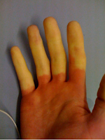 Saiba o que é a doença do dedo branco causada pela vibração