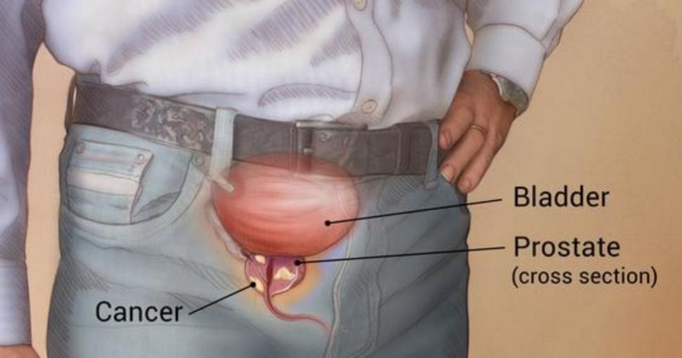 Advanced Prostate Cancer Life Expectancy CancerOz