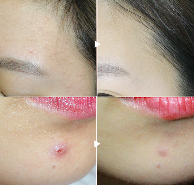 review kem trị mụn pair acne nhánh chóng giá rẻ review kem trị mụn pair acne nhánh chóng giá rẻ